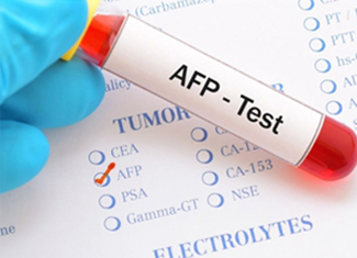 Blood collection tube labelled AFP test on a tumor-marker request form